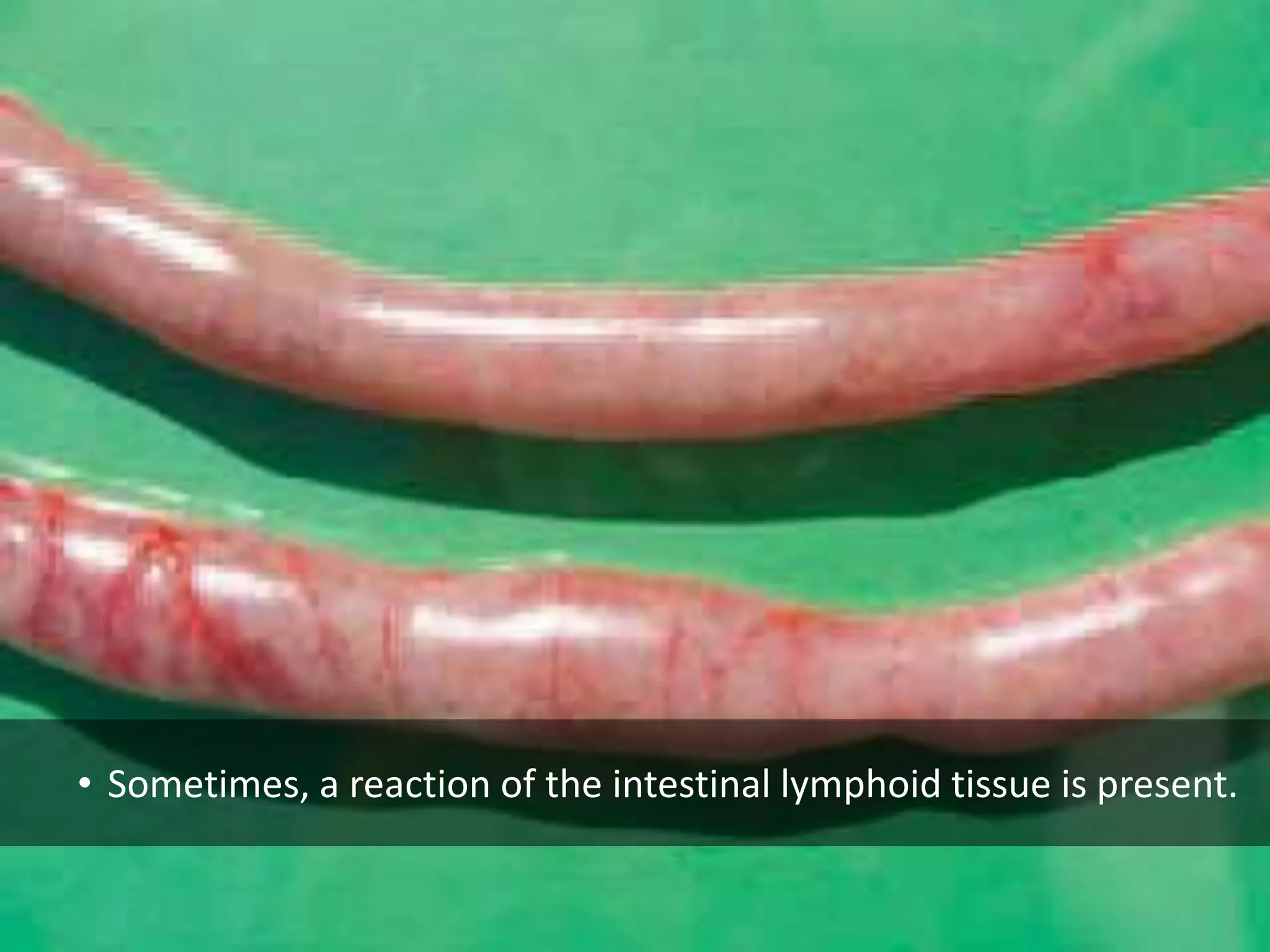• Sometimes, a reaction of the intestinal lymphoid tissue is present.
 