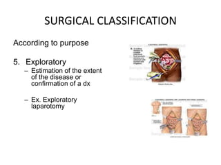 SURGICAL CLASSIFICATION
According to purpose

5. Exploratory
  – Estimation of the extent
    of the disease or
    confirmation of a dx

  – Ex. Exploratory
    laparotomy
 