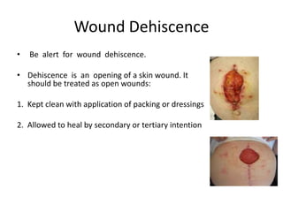 Wound Dehiscence
•   Be alert for wound dehiscence.

• Dehiscence is an opening of a skin wound. It
  should be treated as open wounds:

1. Kept clean with application of packing or dressings

2. Allowed to heal by secondary or tertiary intention
 