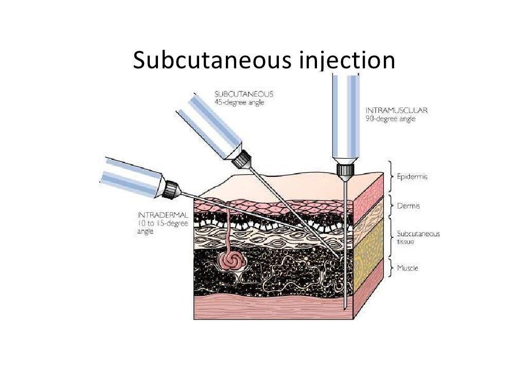 Field injection. Four types of injection. injection choice. varias tip of injection choice.