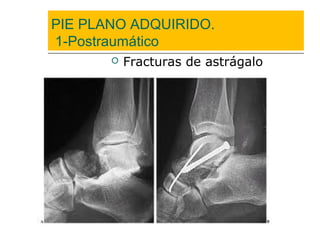 PIE PLANO ADQUIRIDO.
1-Postraumático
 Fracturas de astrágalo
 
