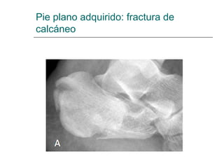 Pie plano adquirido: fractura de
calcáneo
 