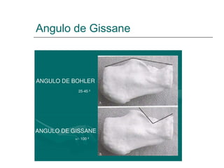 Angulo de Gissane
 