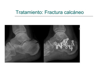 Tratamiento: Fractura calcáneo
 