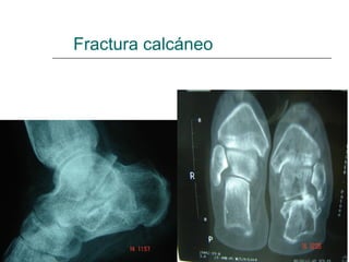 Fractura calcáneo
 