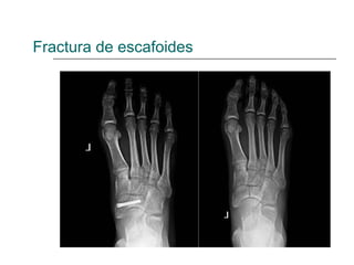 Fractura de escafoides
 