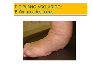 PIE PLANO ADQUIRIDO:
Enfermedades óseas
 