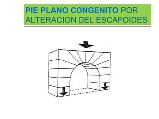 PIE PLANO CONGENITO POR
ALTERACION DEL ESCAFOIDES
 