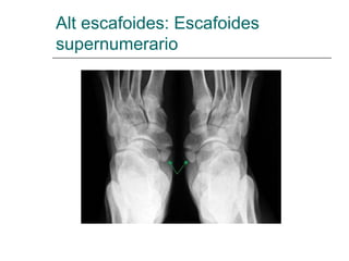 Alt escafoides: Escafoides
supernumerario
 