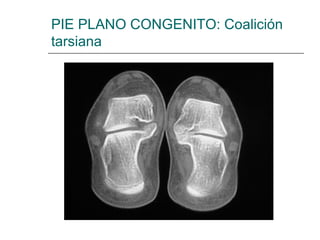 PIE PLANO CONGENITO: Coalición
tarsiana
 