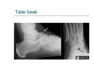 Talar beak
 