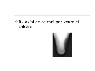  Rx axial de calcani per veure el
calcani
 