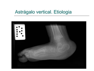 Astrágalo vertical. Etiologia
 