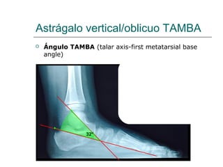 Astrágalo vertical/oblicuo TAMBA
 Ángulo TAMBA (talar axis-first metatarsial base
angle)
 