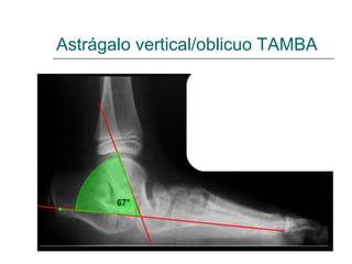 Astrágalo vertical/oblicuo TAMBA
 