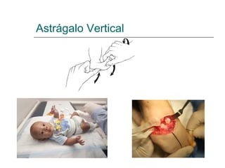 Astrágalo Vertical
 
