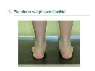 1- Pie plano valgo laxo flexible
 