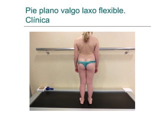 Pie plano valgo laxo flexible.
Clínica
 