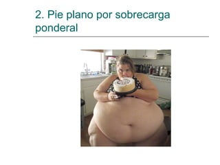 2. Pie plano por sobrecarga
ponderal
 