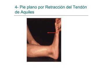 4- Pie plano por Retracción del Tendón
de Aquiles
 