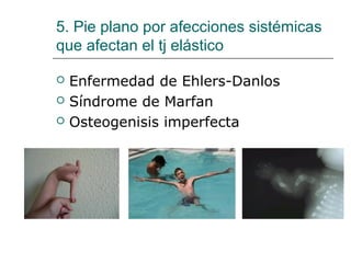 5. Pie plano por afecciones sistémicas
que afectan el tj elástico
 Enfermedad de Ehlers-Danlos
 Síndrome de Marfan
 Osteogenisis imperfecta
 