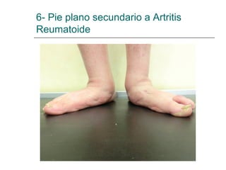 6- Pie plano secundario a Artritis
Reumatoide
 