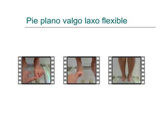 Pie plano valgo laxo flexible
 