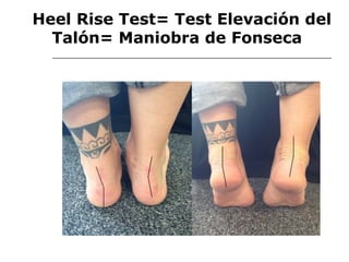 Heel Rise Test= Test Elevación del
Talón= Maniobra de Fonseca
 