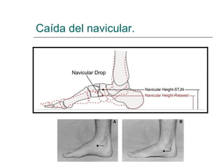 Caída del navicular.
 