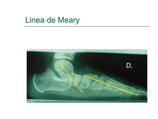 Linea de Meary
 