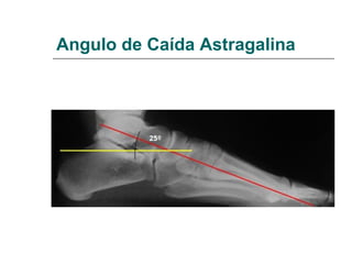 Angulo de Caída Astragalina
 