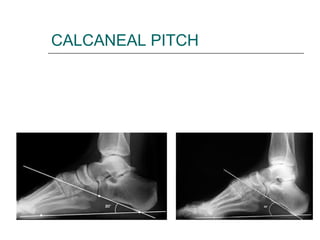 CALCANEAL PITCH
 
