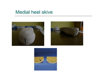 Medial heel skive
 
