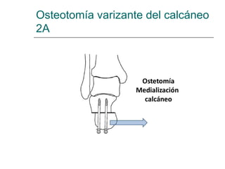 Osteotomía varizante del calcáneo
2A
 