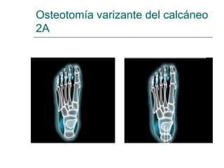 Osteotomía varizante del calcáneo
2A
 