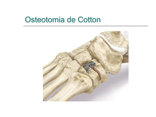Osteotomia de Cotton
 