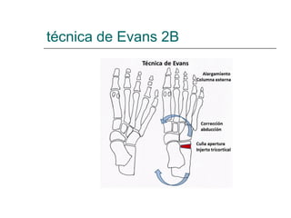 técnica de Evans 2B
 