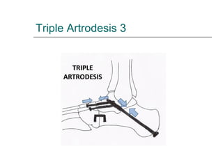 Triple Artrodesis 3
 
