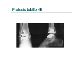 Protesis tobillo 4B
 