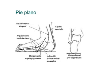 Pie plano
 