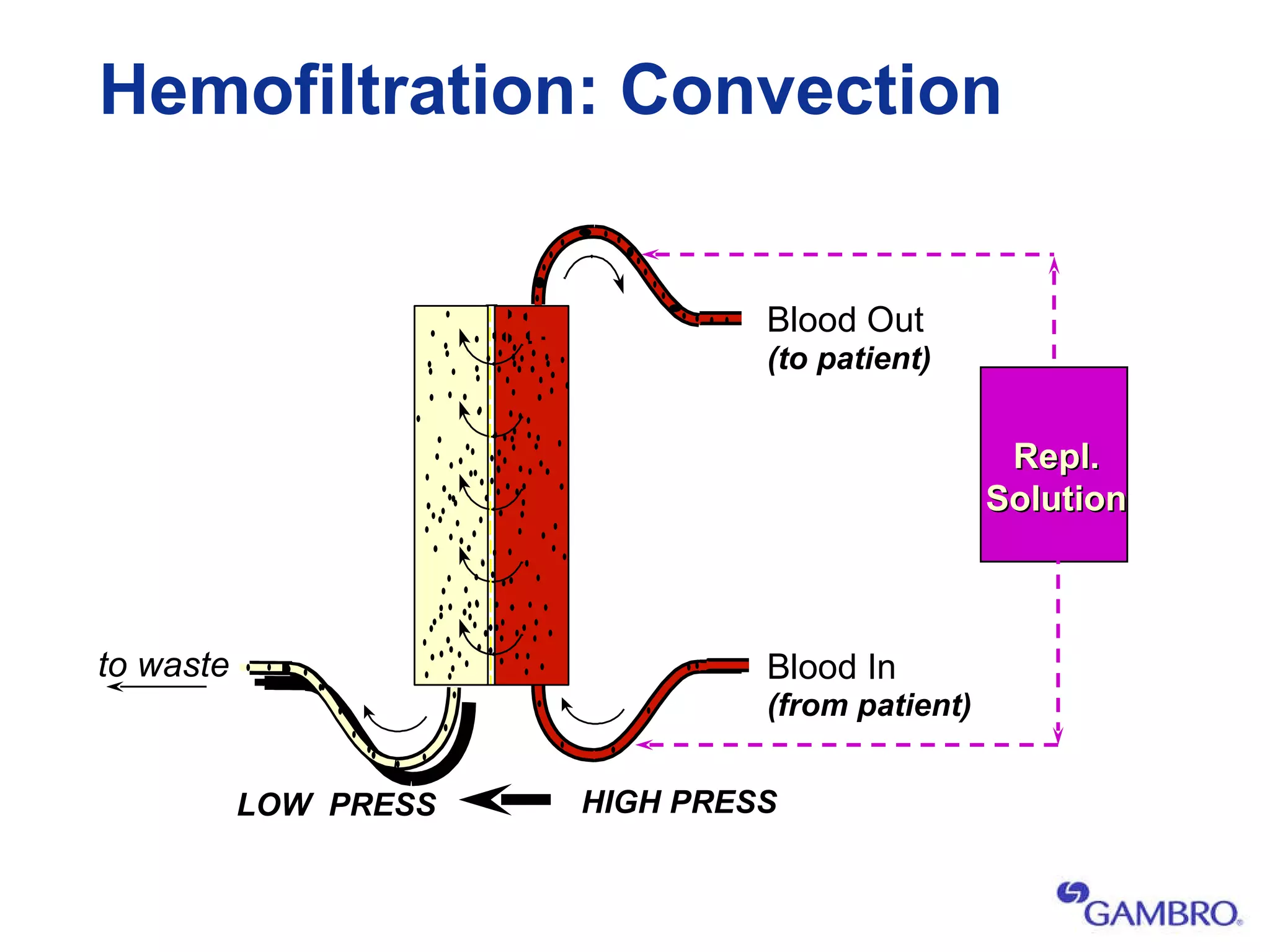 Hemofiltration: Convection to waste HIGH PRESS LOW  PRESS Repl. Solution Blood Out Blood In (to patient) (from patient) 