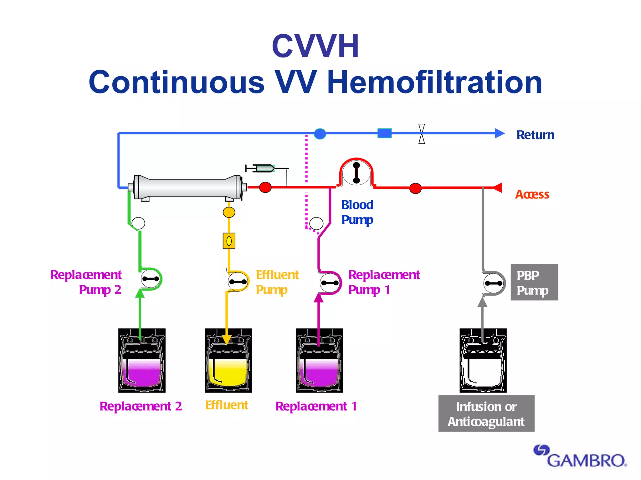 CVVH Continuous VV Hemofiltration Effluent Pump Blood Pump Effluent Access Return Replacement Pump 1 Replacement Pump 2 Replacement 1 Replacement 2 Infusion or Anticoagulant PBP Pump 