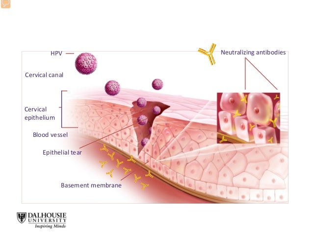 Active protection via vaccination is mediated byneutralizing antibodies at the cervix HPV Cervical canal Neutralizing ant...