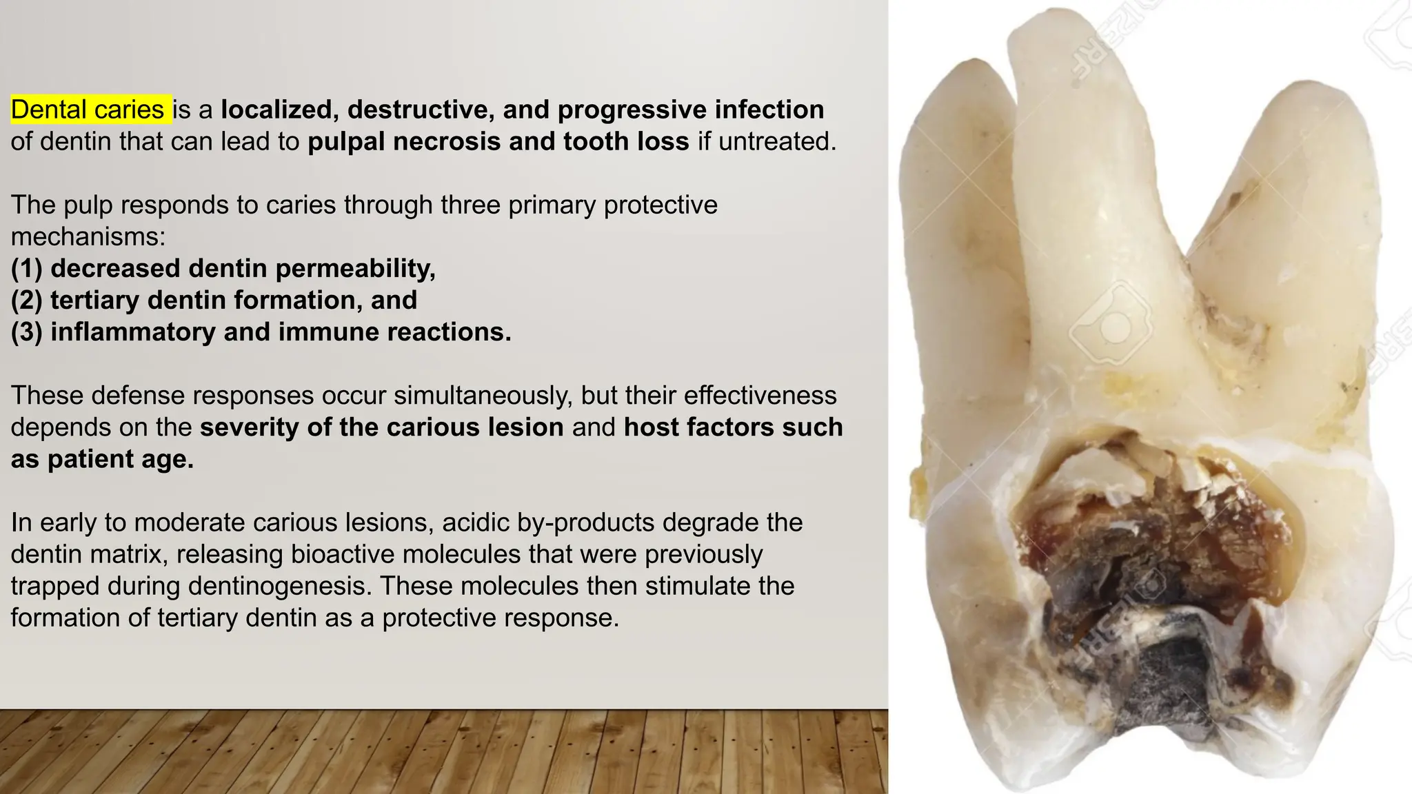 Pulp Caries 1- Pulpal Response to dental caries, Various Dental Procedures ...