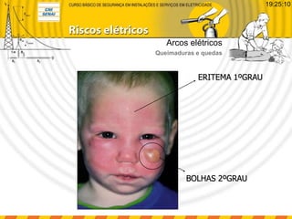 ERITEMA 1ºGRAU
BOLHAS 2ºGRAU
Arcos elétricos
Queimaduras e quedas
19:25:10
 