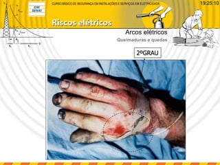 2ºGRAU
Arcos elétricos
Queimaduras e quedas
19:25:10
 