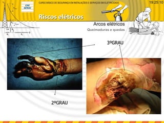 3ºGRAU
2ºGRAU
Arcos elétricos
Queimaduras e quedas
19:25:10
 