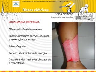 LOCALIZAÇÃO ESPECIAIS.
Mãos e pés: Seqüelas severas.
Face:Queimaduras de V.A.S, inalação
e intoxicação por fumaça.
Olhos: Cegueira.
Períneo: Alta incidência de infecção.
Circunferências: restrições circulatórias
e respiratórias.
Arcos elétricos
Queimaduras e quedas
 