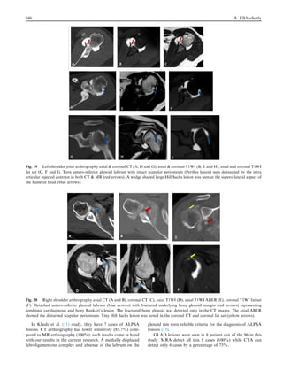 In Khedr et al. (11) study, they have 7 cases of ALPSA
lesions. CT arthrography has lower sensitivity (85.7%) com-
pared to MR arthrography (100%); such results come in hand
with our results in the current research. A medially displaced
labroligamentous complex and absence of the labrum on the
glenoid rim were reliable criteria for the diagnosis of ALPSA
lesions (15).
GLAD lesions were seen in 8 patient out of the 96 in this
study. MRA detect all this 8 cases (100%) while CTA can
detect only 6 cases by a percentage of 75%.
Fig. 19 Left shoulder joint arthrography axial  coronal CT (A, D and G), axial  coronal T1WI (B, E and H), axial and coronal T1WI
fat sat (C, F and I). Torn antero-inferior glenoid labrum with intact scapular periosteum (Perthes lesion) seen delineated by the intra
articular injected contrast in both CT  MR (red arrows). A wedge shaped large Hill Sachs lesion was seen at the supero-lateral aspect of
the humeral head (blue arrows).
Fig. 20 Right shoulder arthrography axial CT (A and B), coronal CT (C), axial T1WI (D), axial T1WI ABER (E), coronal T1WI fat sat
(F). Detached antero-inferior glenoid labrum (blue arrows) with fractured underlying bony glenoid margin (red arrows) representing
combined cartilaginous and bony Bankart’s lesion. The fractured bony glenoid was detected only in the CT images. The axial ABER
showed the disturbed scapular periosteum. Tiny Hill Sachs lesion was noted in the coronal CT and coronal fat sat (yellow arrows).
946 A. Elkharbotly
 