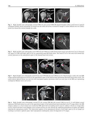 Fig. 3 Right shoulder joint arthrography coronal T1WI (A) and coronal T2WI (B) showed detached axillary pouch from its glenoid
attachment (GAGL lesion) and leakage of contrast into the axilla (red arrow). Coronal CT (image C) cannot delineate the torn axillary
pouch but showed the contrast leakage into axilla.
Fig. 4 Right shoulder joint arthrography axial T1WI (A) and T1WI fat sat (B) showed small cortical and subcortical area of abnormal
low signal on T1WI and bright signal on fat sat representing small Hill Sachs lesion. The Axial CT (C) at the same level showed tiny
cortical depression at the superolateral aspect of the humeral head (red arrows).
Fig. 5 Right shoulder joint arthrography axial CT (A), axial T1WI (B) and axial T1WI fat sat (C). The CT image as well as the axial MR
images showed small depression fracture at the superolateral aspect of the humeral head representing Hill Sachs lesion (blue arrow). The
antero-inferior glenoid labrum was seen torn with interrupted scapular periosteum which was more clear in the MR scan representing
cartilaginous Bankart lesion (red arrow).
Fig. 6 Right shoulder joint arthrography coronal CT (A), coronal TWI (B) and coronal T1WI fat sat (C). A well deﬁned cortical
depression (Hill Sachs lesion) was seen at the superolateral aspect of the humeral head clearly identiﬁed in the CT image while in the MR
images it appears as a focal cortical area of abnormal MR signal with surrounding reactive marrow oedema in the fat sat images (blue
arrow). Lateral and down ward slopping of the acromion process was seen effacing the underlying peritendinous fat plane and slightly
indenting the supraspinatus tendon. The subacromial segment of the supraspinatus showed a focal bright signal on fat sat images not
reaching its acromial or glenoid aspect. Such supraspinatus tendinopathy cannot be diagnosed in CT images.
940 A. Elkharbotly
 